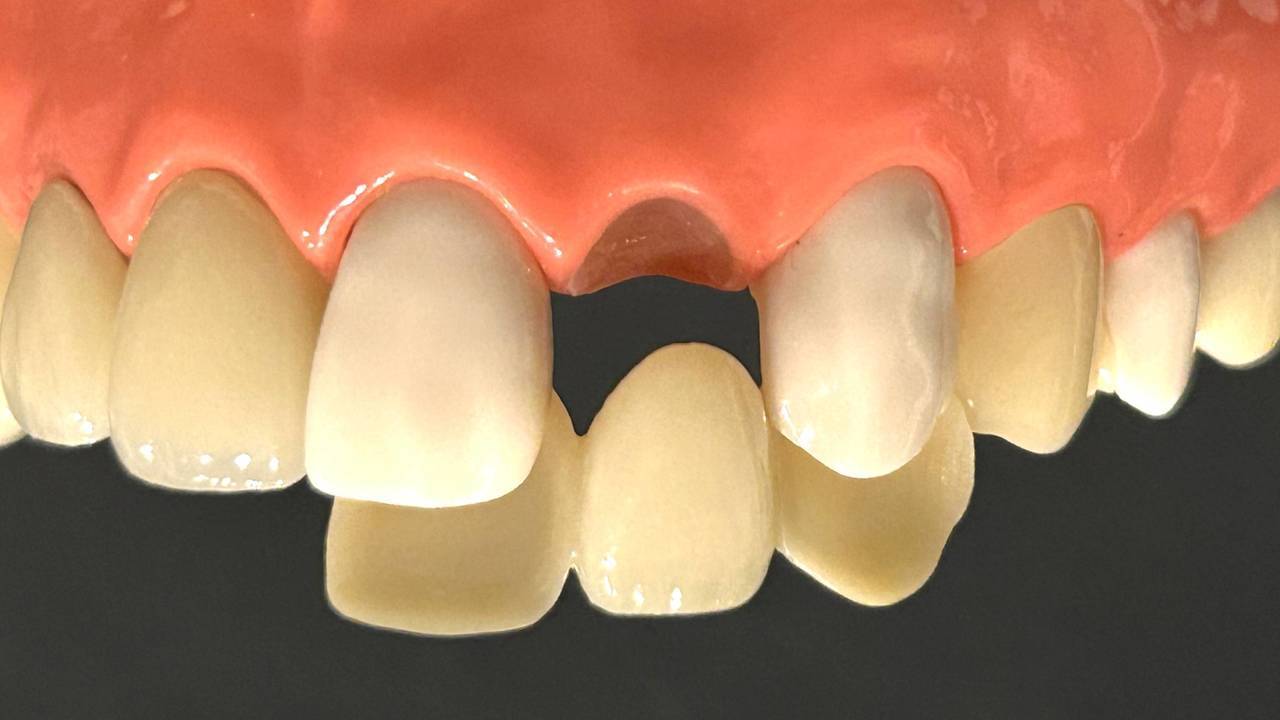 春日井市のあまり削らないブリッジ（ジルコニア接着ブリッジ）