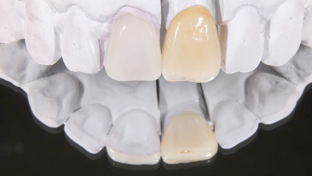 春日井市のラミネートベニア