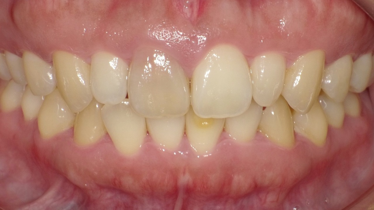 春日井市のホワイトニング