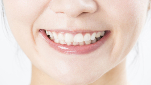 春日井市のラミネートベニア