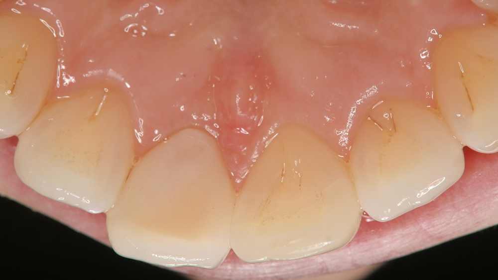 春日井市のジルコニア