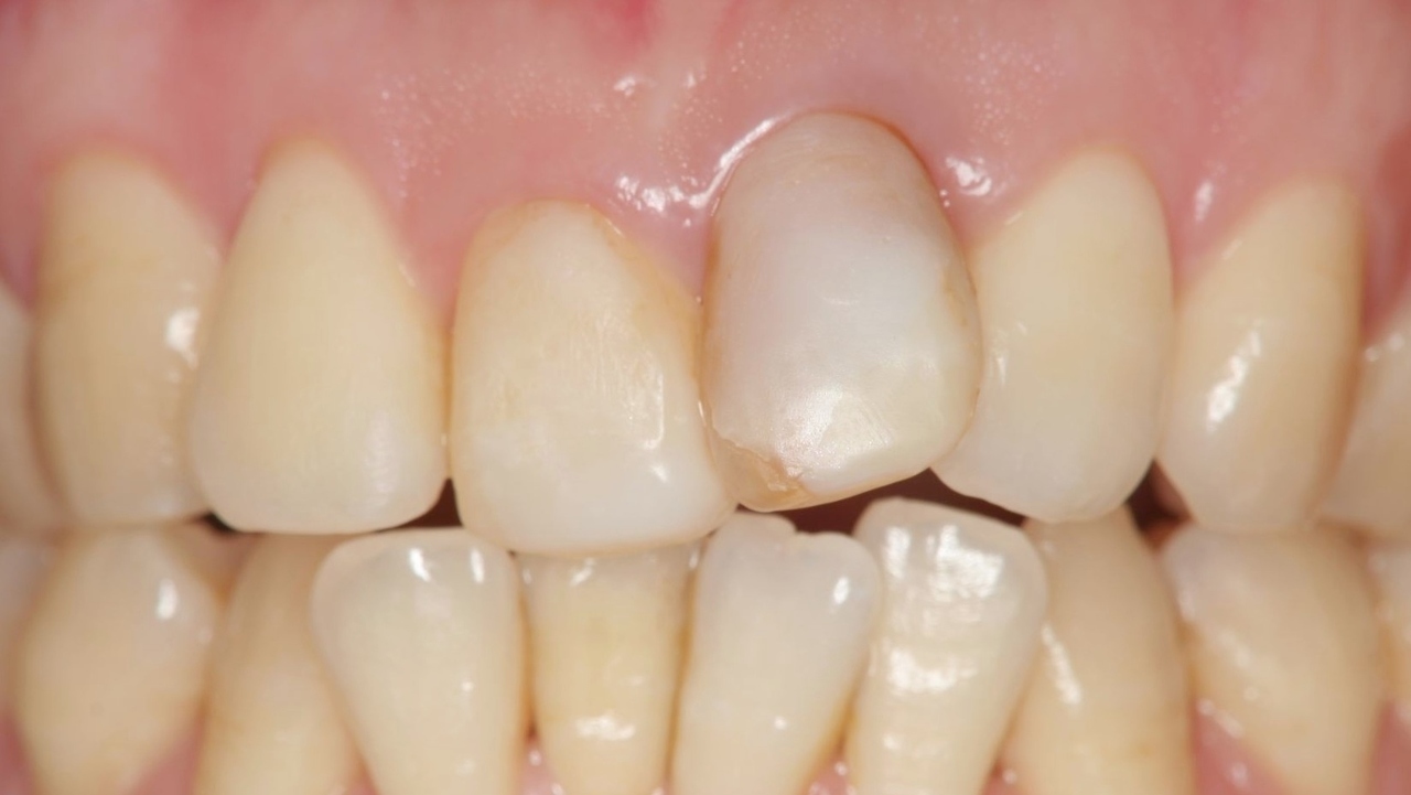 春日井市のラミネートベニア