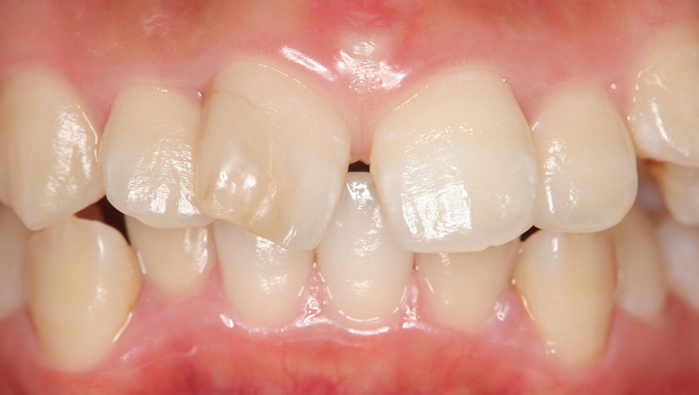 春日井市のジルコニア