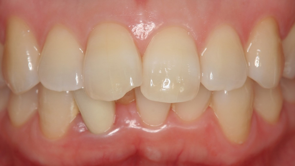 春日井市のジルコニア