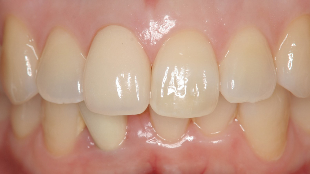 春日井市のジルコニア