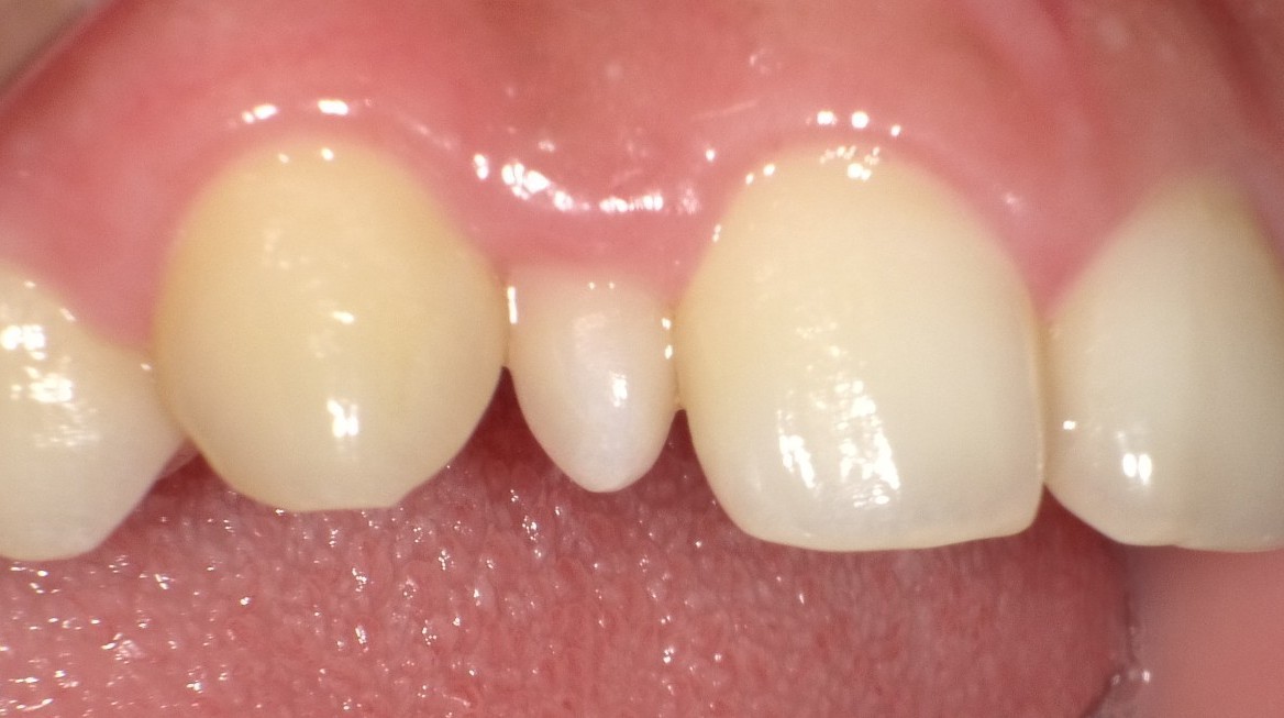 春日井市の審美歯科