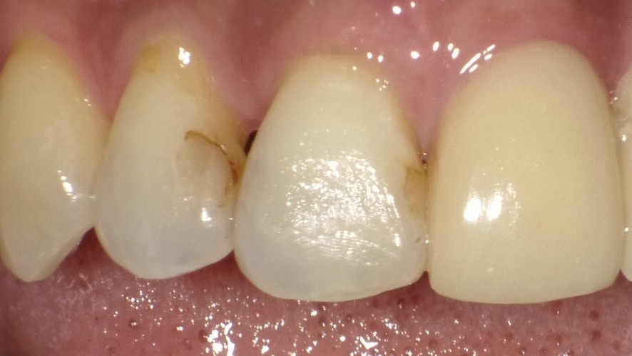 春日井市のダイレクトボンディング