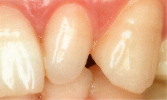 春日井市のダイレクトボンディング