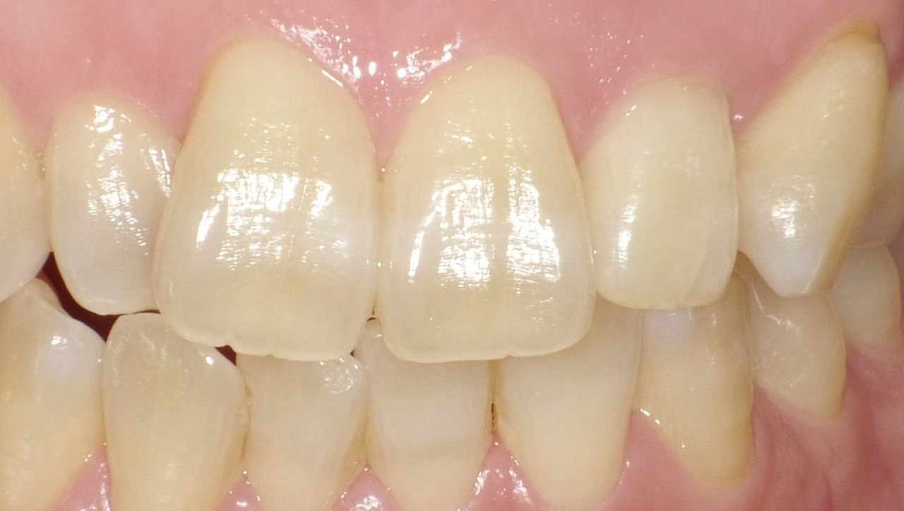 春日井市のホワイトニング