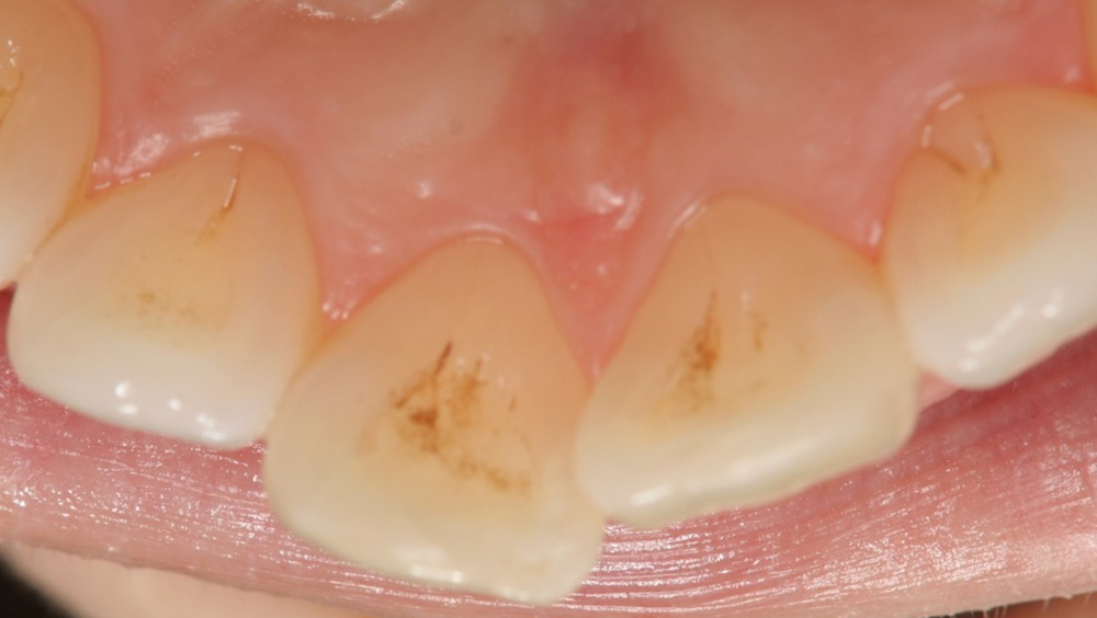 春日井市のジルコニア