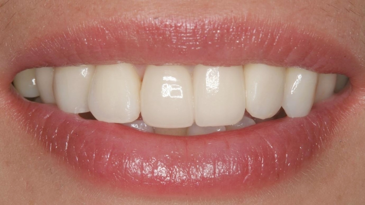 春日井市のラミネートベニア