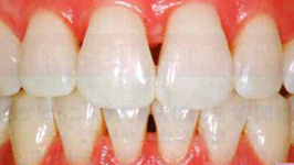 春日井市のダイレクトボンディング