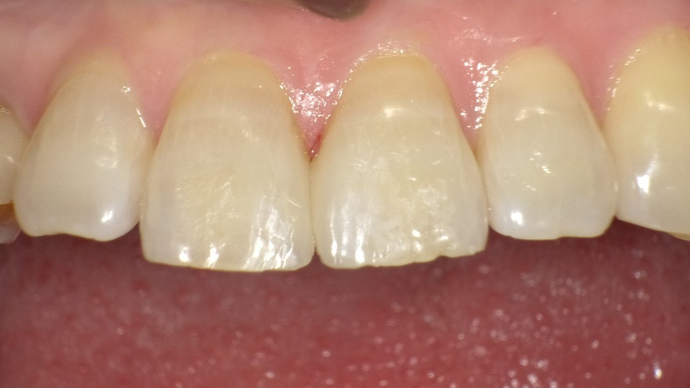 春日井市のダイレクトボンディング