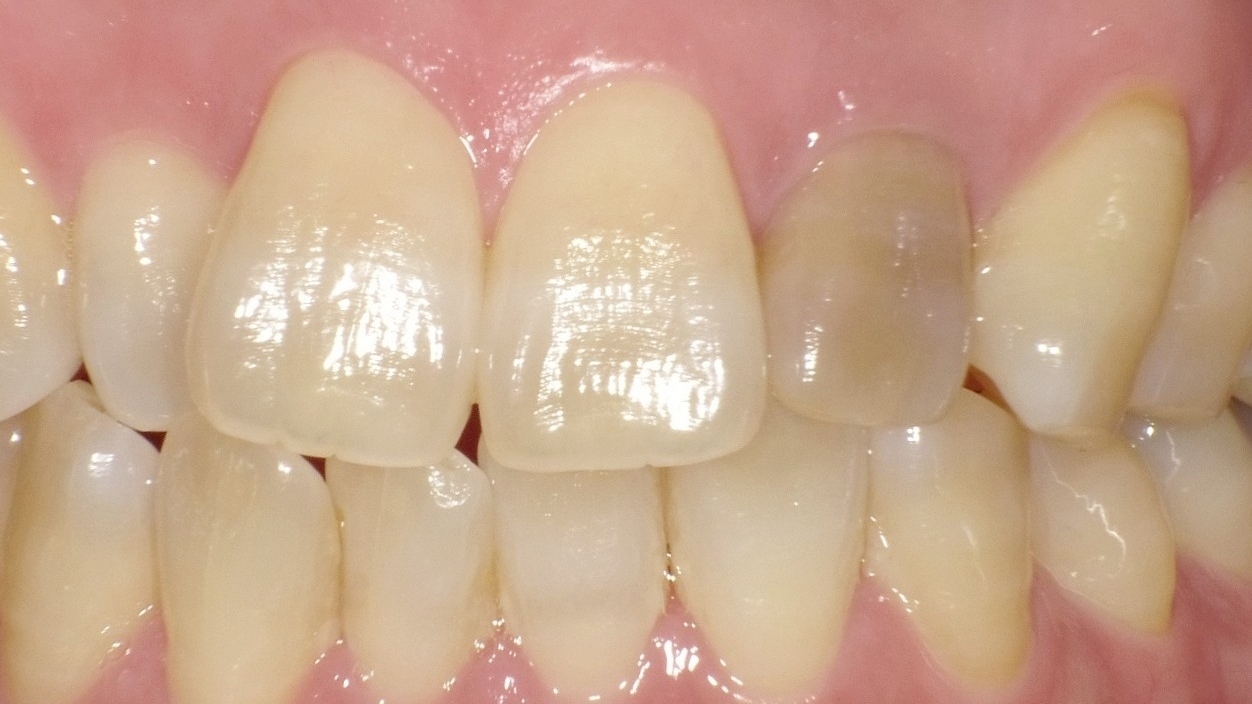 春日井市のホワイトニング