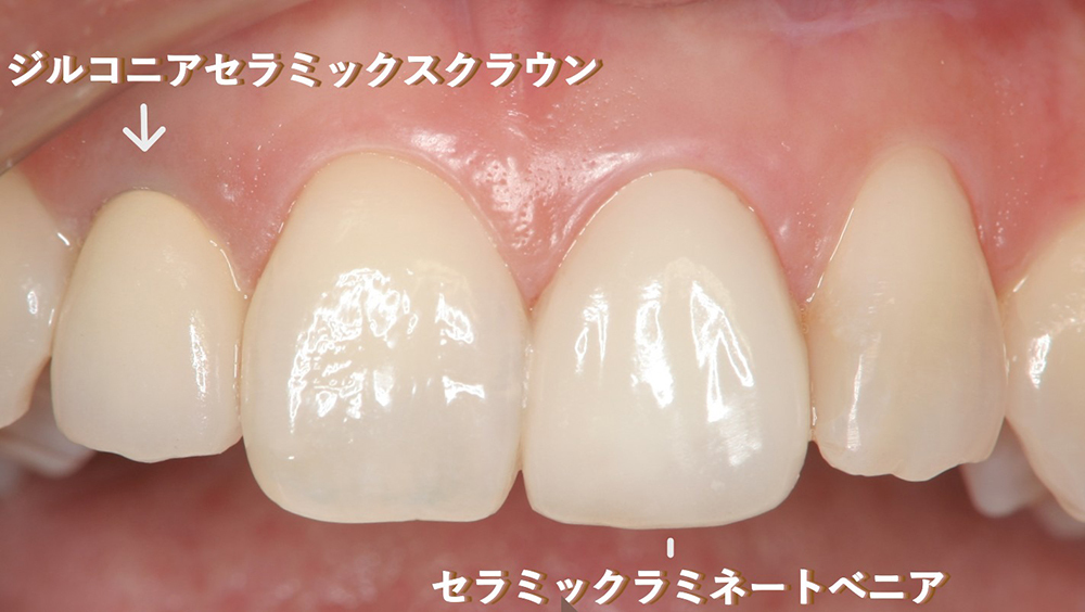 春日井市のジルコニア