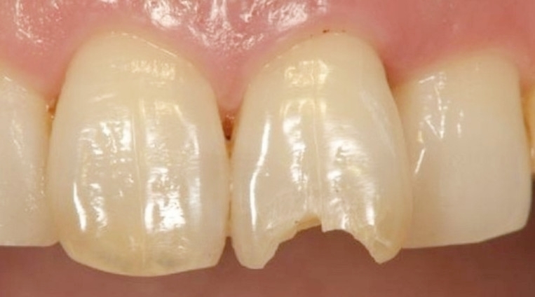 春日井市のダイレクトボンディング