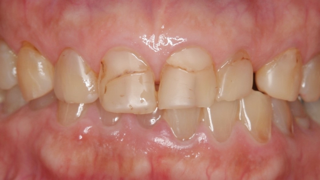 春日井市のラミネートベニア