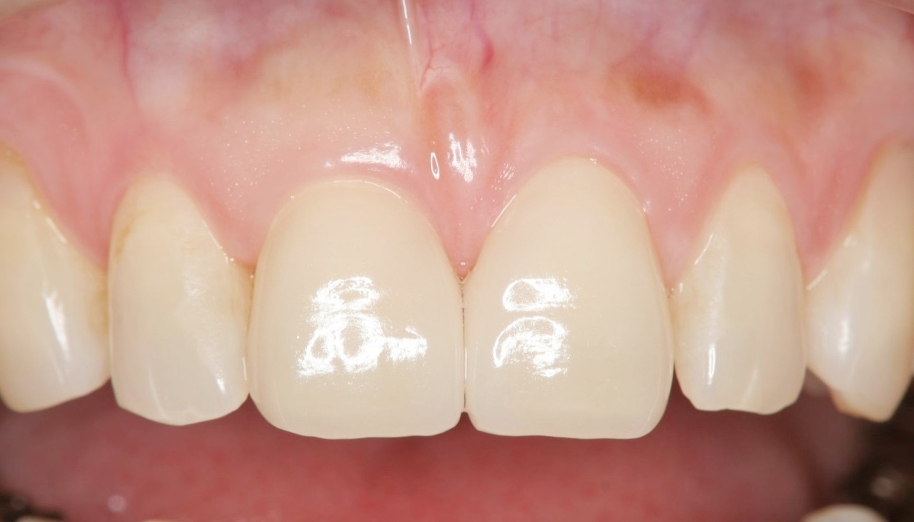 春日井市のラミネートベニア