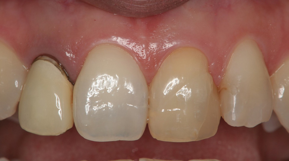 春日井市のジルコニア