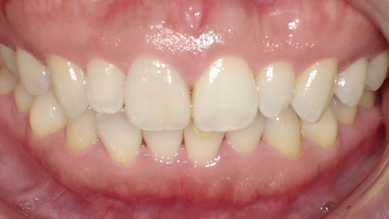 春日井市のホワイトニング