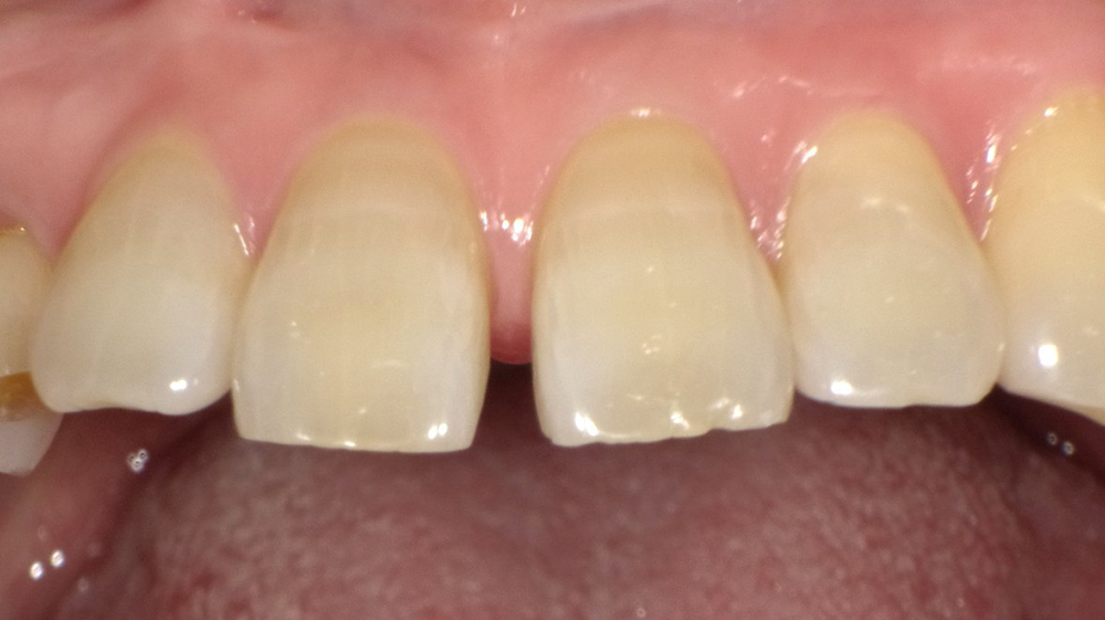 春日井市のダイレクトボンディング