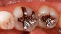 春日井市のダイレクトボンディング