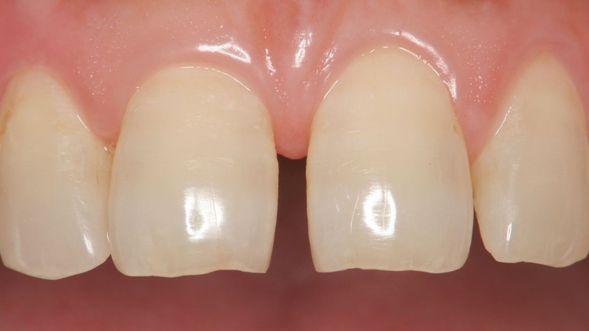 春日井市のダイレクトボンディング