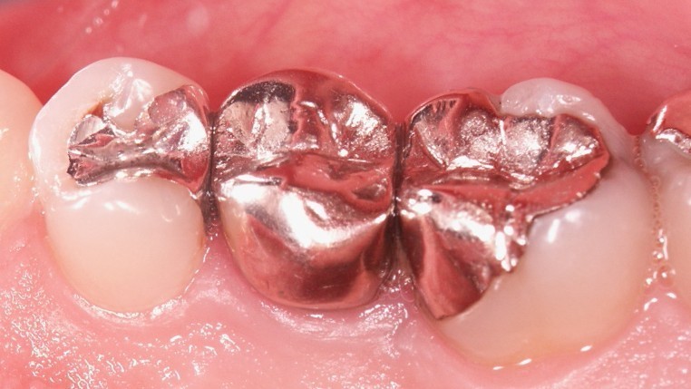 春日井市の審美歯科