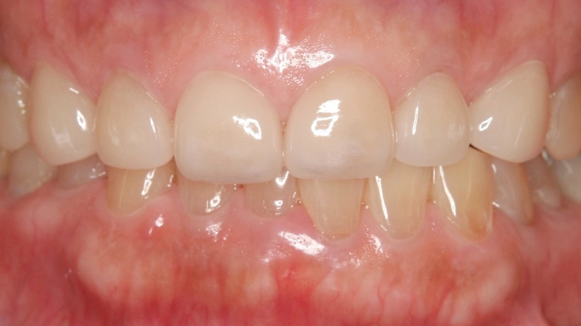 春日井市のラミネートベニア