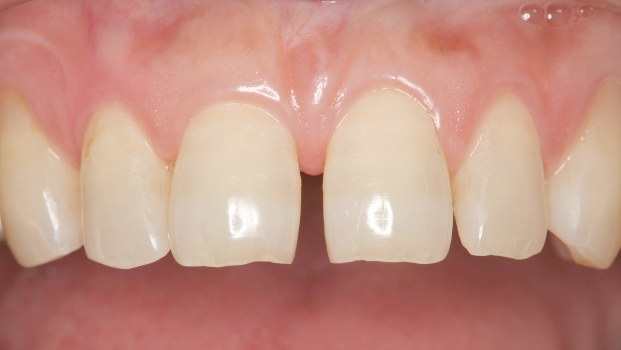 春日井市のラミネートベニア