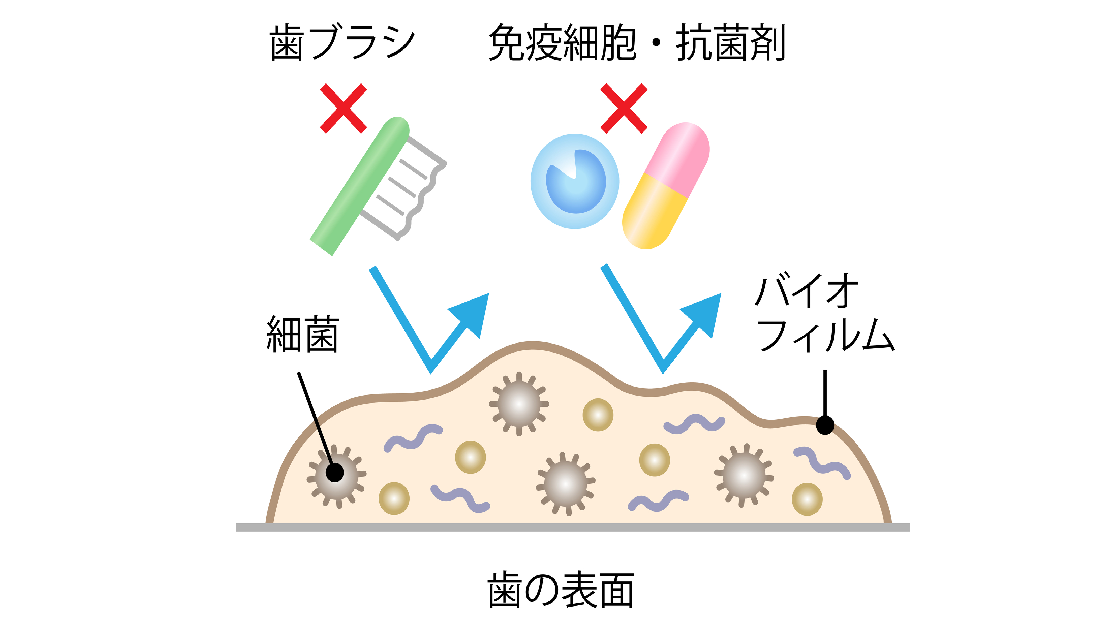 春日井市で歯のPMTC・パウダートリートメント