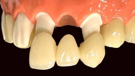 あまり削らないブリッジ（ジルコニア接着ブリッジ） - 加藤歯科医院